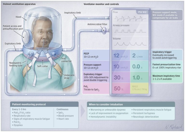 Estudo compara os efeitos da ventilação com capacete e oxigenoterapia de alto fluxo em pacientes com COVID-19